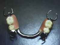 partial partial dentures