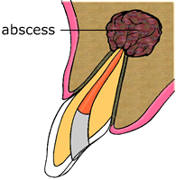 Root Canal Therapy Root Canal Therapy