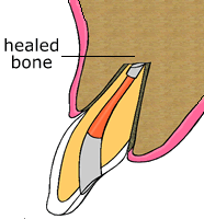 Root Canal Therapy Root Canal Therapy