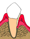Root Canal Therapy Root Canal Therapy