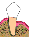 Root Canal Therapy Root Canal Therapy