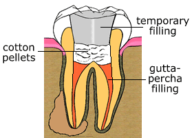 Root Canal Therapy Root Canal Therapy