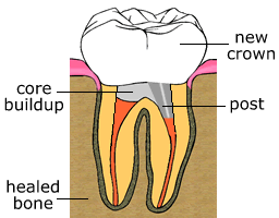 Root Canal Therapy Root Canal Therapy